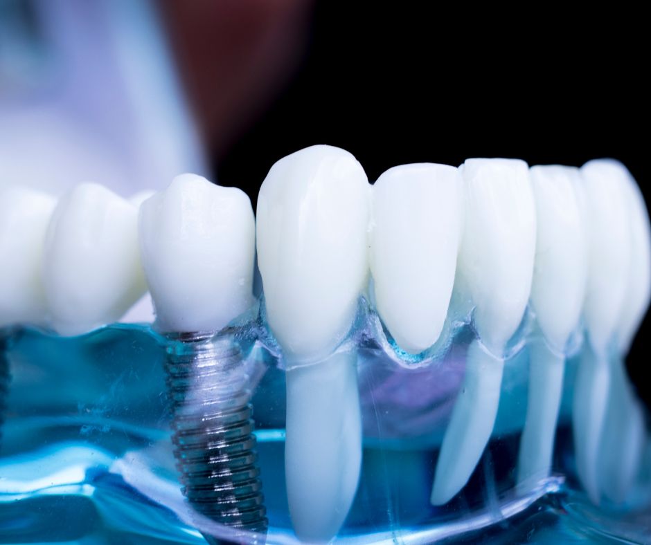 You are currently viewing ￼Mituri legate de implanturile dentare