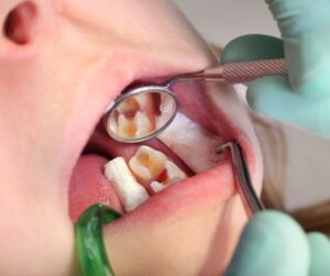 Read more about the article Fractura dentară