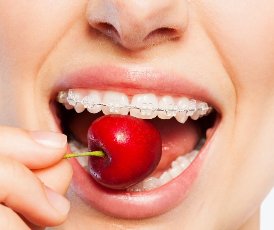 You are currently viewing Ce alimente se pot consuma când porți aparat dentar